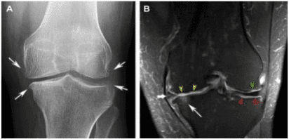 knee xray Imaging of Osteoarthritis in the knee (Hunter DJ (1999)4 Fig 1).