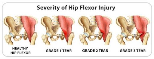 Figure 2. Severity of hip flexor strain https-::gohockeynews.com:sports-medicine-hip-flexor-strain-a-long-term-problem-for-hockey-players: Figure 2. Severity of hip flexor strain https://gohockeynews.com/sports-medicine-hip-flexor-strain-a-long-term-problem-for-hockey-players/