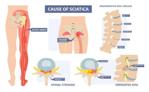 unnamed (1) Cause of sciatica