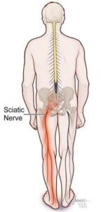sciatic nerve pain sciatic nerve pain