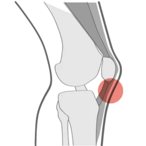 Patellar Tendinopathy