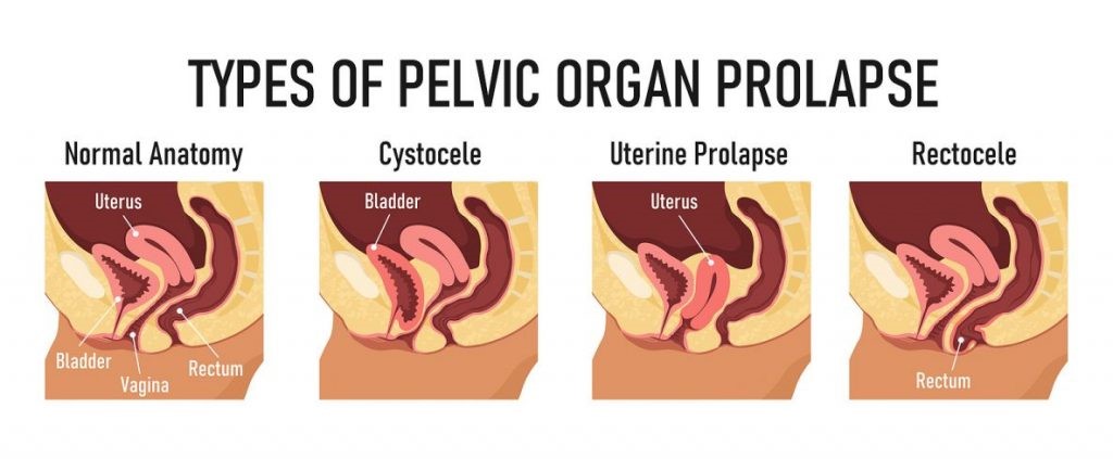 Pelvic Organ Prolapse